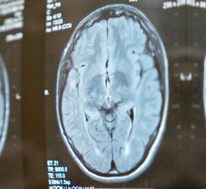 traumatic-brain