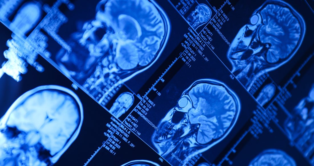 tbi symptoms